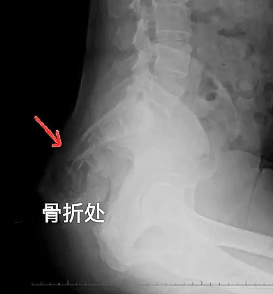 摔跤屁股疼莫轻视小心是尾骨骨折