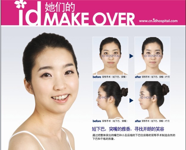 韩国脸型整形突嘴的改善方法_首页国内_新闻
