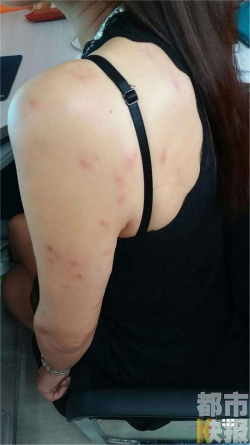 女子在西安租房三个月 全身被臭虫咬一身疤痕