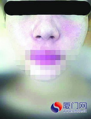 小娜在注射玻尿酸后脸颊红肿。