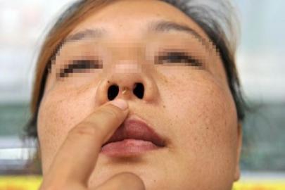 李素鼻子整形后出现溃烂灌脓现象。