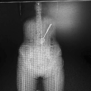 女子吞下15厘米钢勺 CT拍片