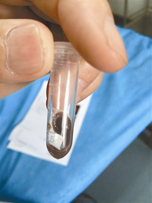 医生取出水蛭后测量，竟长达10厘米。