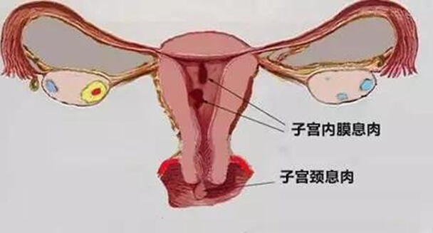 少女患子宫息肉恍惚疲倦 担心处女膜受损不愿手术