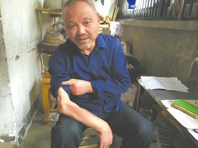 胡东屏10多岁的时候,右手得了骨结核,导致肘部肢体变形,行动不便。