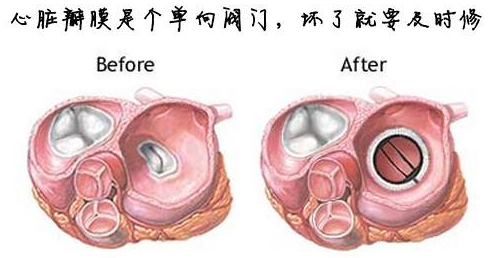 感冒发烧拖着不治险丢命男子心脏瓣膜烂了