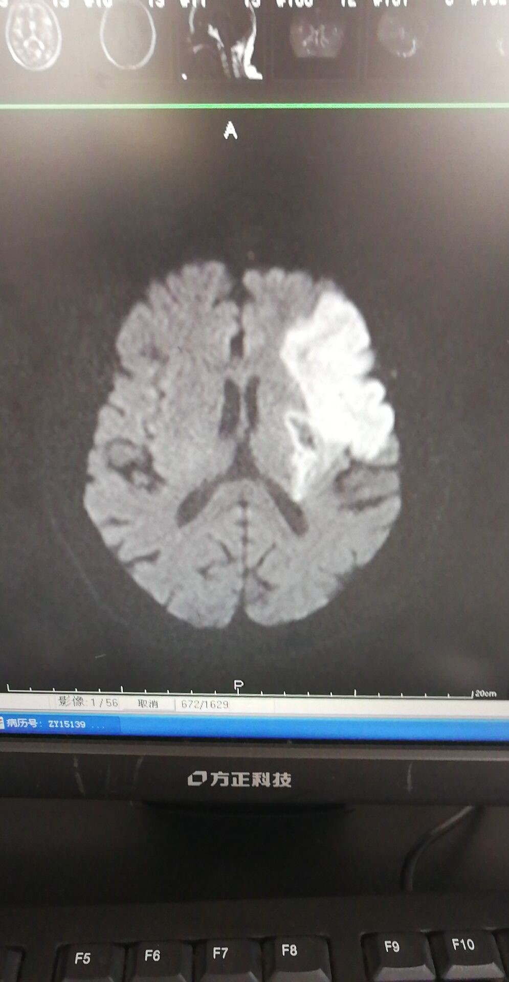 脑梗诊断报告图片图片