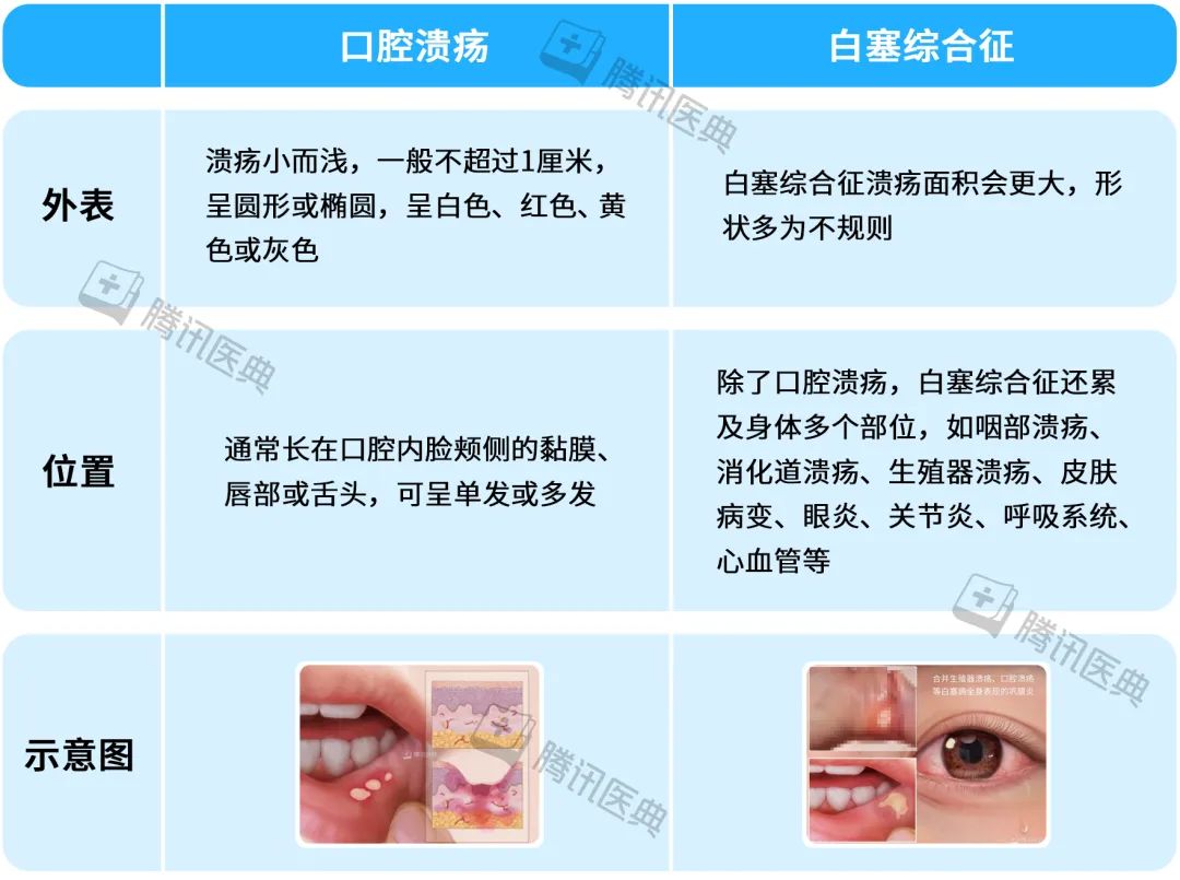 不同类型口腔溃疡图解图片