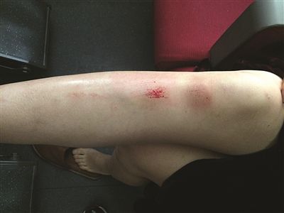 女孩腿刚摔伤照片图片