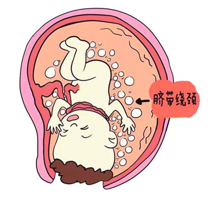 武汉多家医院的统计每35个孕妇就有1个脐带绕颈