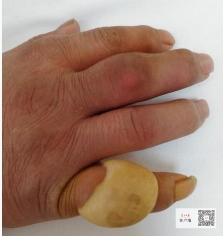 手指关节痛风石图片图片