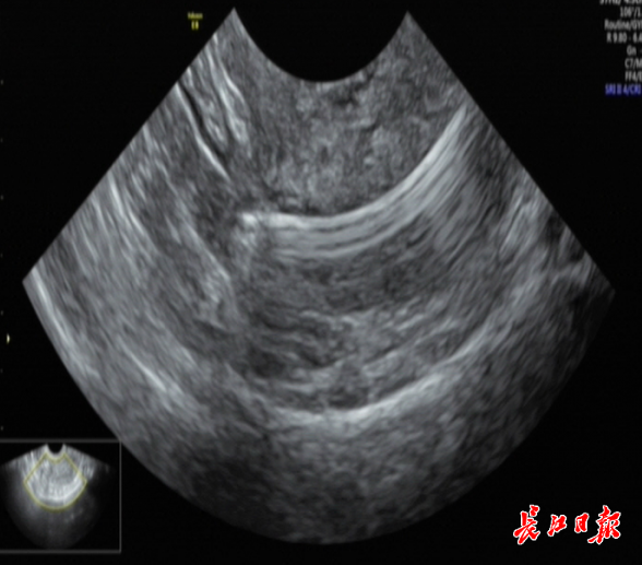 节育环b超图片图片