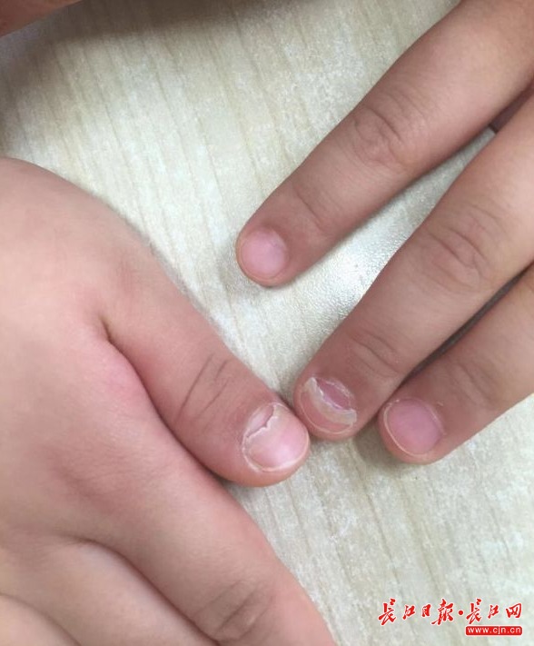 5岁小孩就得灰指甲,还要拔甲?一查才知是手足口病引发的