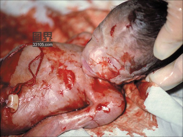 堕胎手术痛苦图片