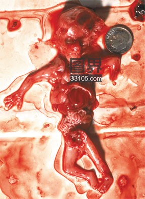 怀孕四个月堕胎图片图片